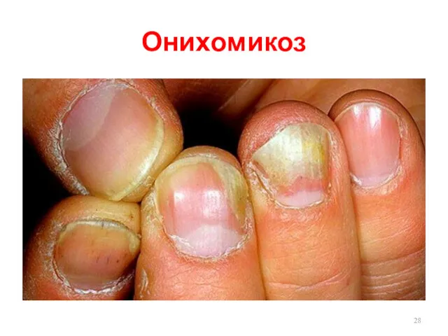 Онихомикоз