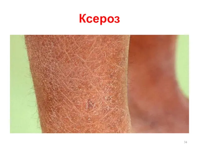 Ксероз