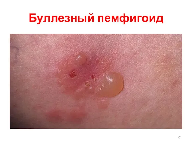 Буллезный пемфигоид