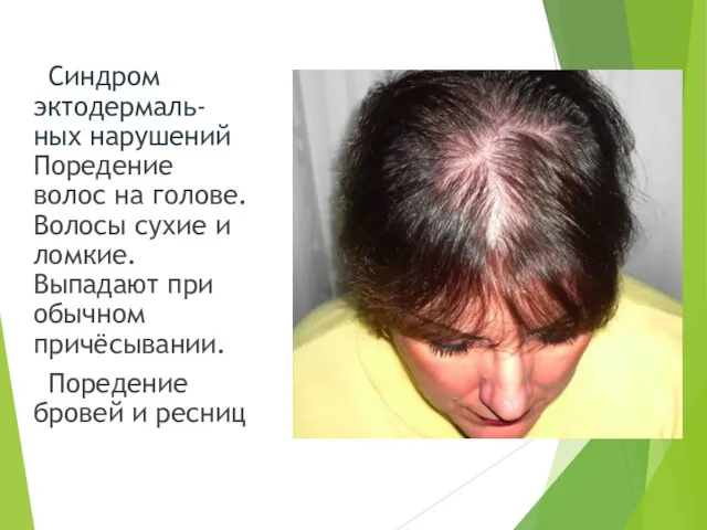 Синдром эктодермаль-ных нарушений Поредение волос на голове. Волосы сухие и