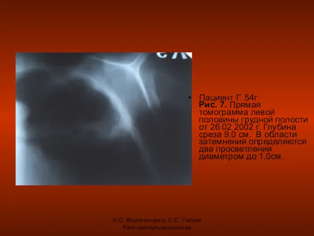 Н.С. Воротынцева, С.С. Гольев Рентгенопульмонология Пациент Г. 54г Рис. 7. Прямая томограмма левой