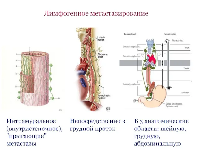 Лимфогенное метастазирование Интрамуральное (внутристеночное), "прыгающие" метастазы Непосредственно в грудной проток В 3 анатомические