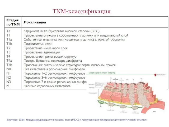 TNM-классификация Критерии TNM: Международный противораковы союз (UICC) и Американский объединенный онкологический комитет.