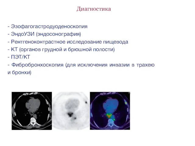 Диагностика - Эзофагогастродуоденоскопия - ЭндоУЗИ (эндосонография) - Рентгеноконтрастное исследование пищевода