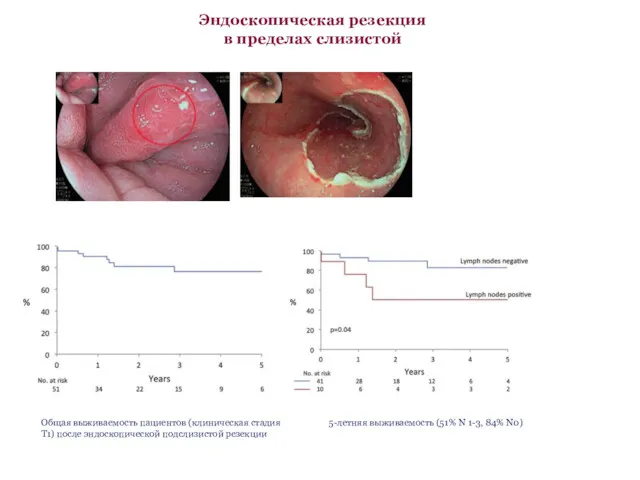 Эндоскопическая резекция в пределах слизистой Общая выживаемость пациентов (клиническая стадия