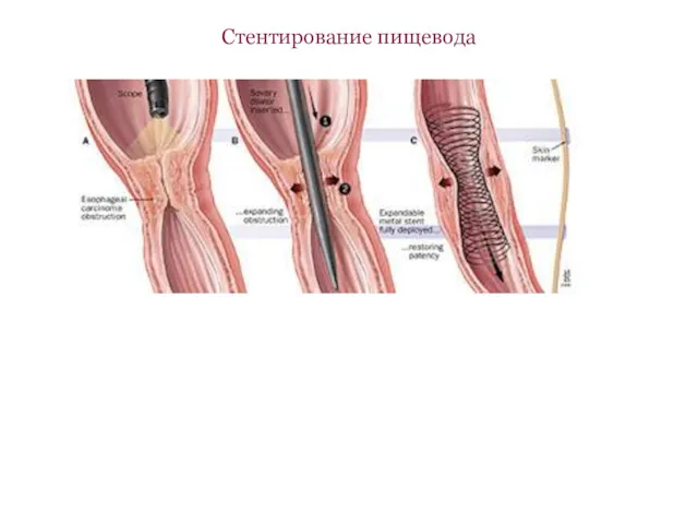 Стентирование пищевода