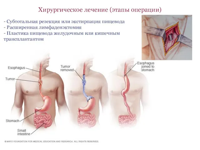 Хирургическое лечение (этапы операции) - Субтотальная резекция или экстирпация пищевода - Расширенная лимфаденэктомия
