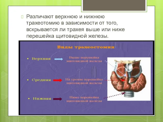 Различают верхнюю и нижнюю трахеотомию в зависимости от того, вскрывается