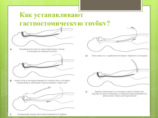 Как устанавливают гастростомическую трубку?