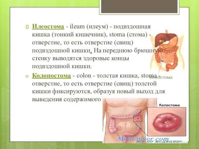 Илеостома - ileum (илеум) - подвздошная кишка (тонкий кишечник), stoma