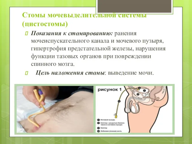 Стомы мочевыделительной системы (цистостомы) Показания к стомированию: ранения мочеиспускательного канала