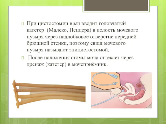 При цистостомии врач вводит головчатый катетер (Малеко, Пеццера) в полость