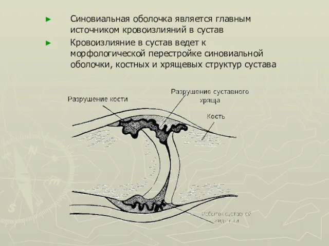 Синовиальная оболочка является главным источником кровоизлияний в сустав Кровоизлияние в