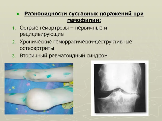 Разновидности суставных поражений при гемофилии: Острые гемартрозы – первичные и