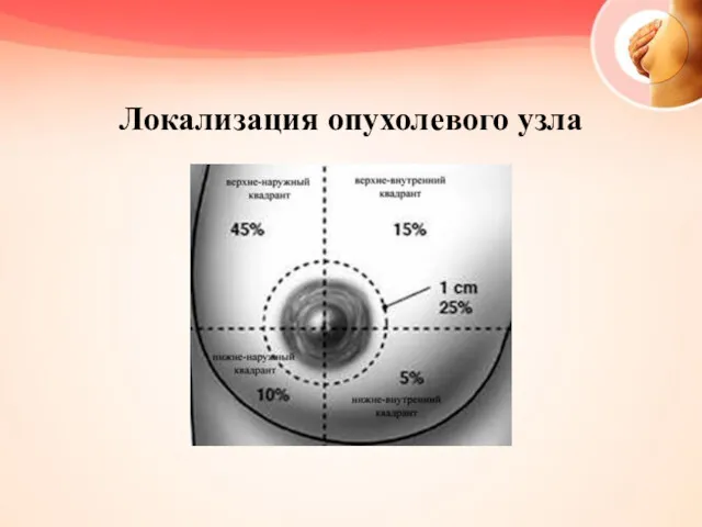 Локализация опухолевого узла