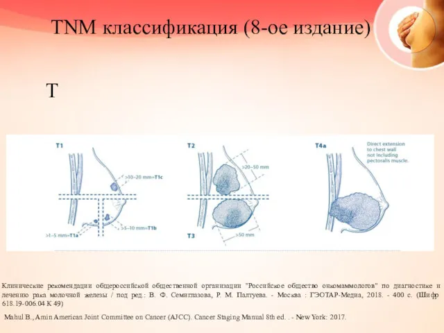 TNM классификация (8-ое издание) T Клинические рекомендации общероссийской общественной организации "Российское общество онкомаммологов"