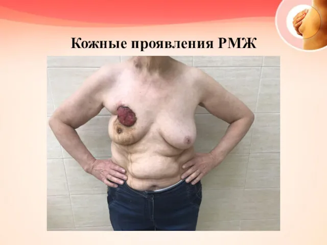 Кожные проявления РМЖ