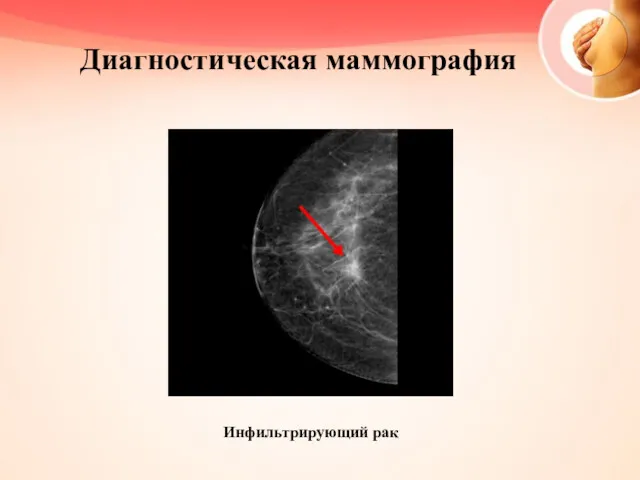 Диагностическая маммография Инфильтрирующий рак