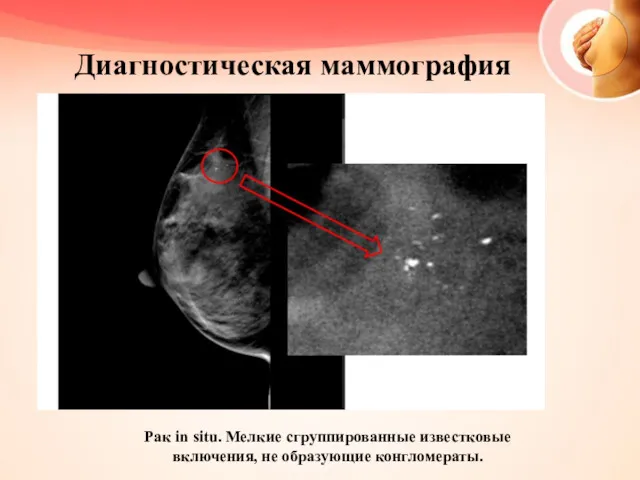 Диагностическая маммография Рак in situ. Мелкие сгруппированные известковые включения, не образующие конгломераты.