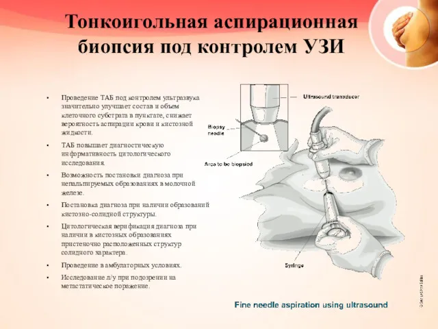 Тонкоигольная аспирационная биопсия под контролем УЗИ Проведение ТАБ под контролем ультразвука значительно улучшает