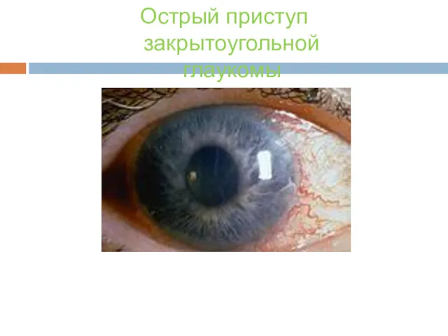 Острый приступ глаукомы Острый приступ закрытоугольной глаукомы