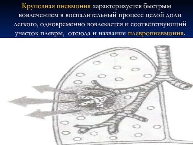 Крупозная пневмония характеризуется быстрым вовлечением в воспалительный процесс целой доли