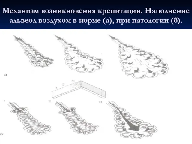 Механизм возникновения крепитации. Наполнение альвеол воздухом в норме (а), при патологии (б).