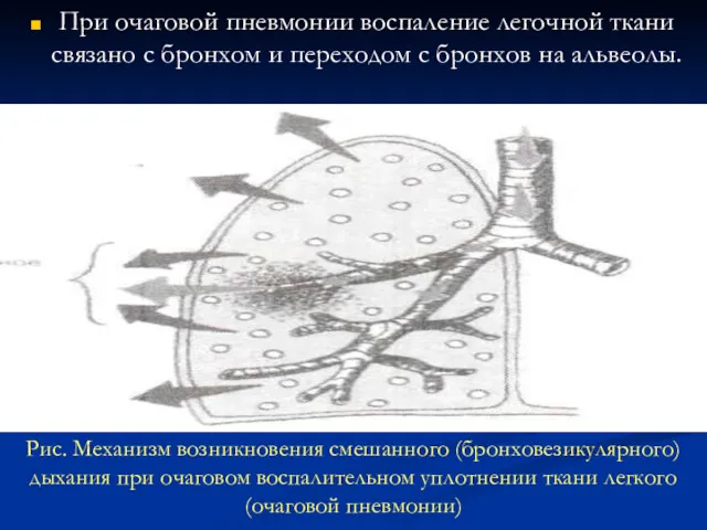 Рис. Механизм возникновения смешанного (бронховезикулярного) дыхания при очаговом воспалительном уплотнении