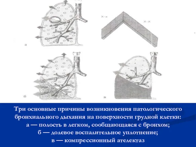 Три основные причины возникновения патологического бронхиального дыхания на поверхности грудной