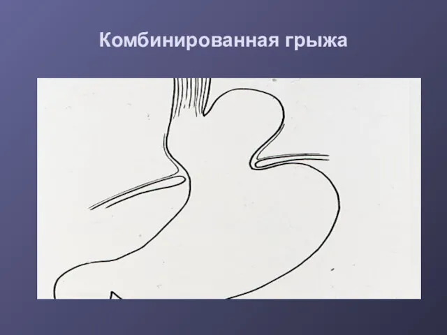 Комбинированная грыжа