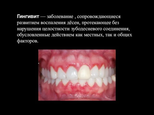 Гингивит — заболевание , сопровождающиеся развитием воспаления дёсен, протекающее без