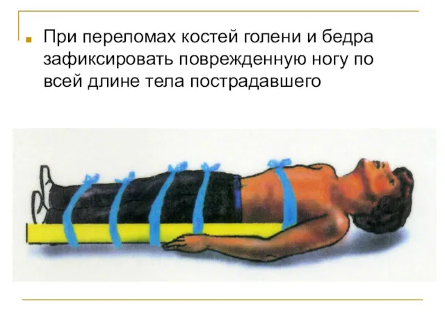 При переломах костей голени и бедра зафиксировать поврежденную ногу по всей длине тела пострадавшего