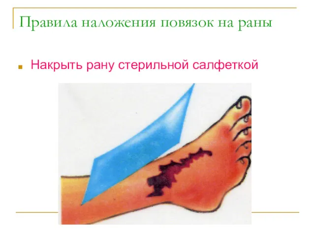 Правила наложения повязок на раны Накрыть рану стерильной салфеткой