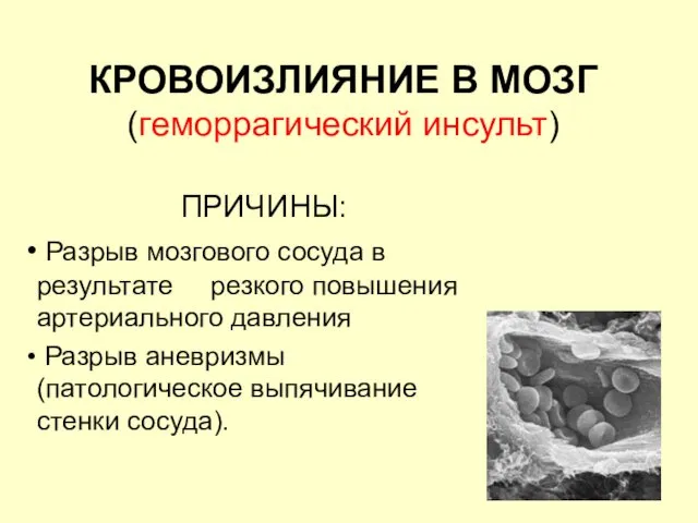 КРОВОИЗЛИЯНИЕ В МОЗГ (геморрагический инсульт) ПРИЧИНЫ: Разрыв мозгового сосуда в