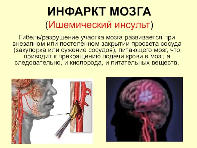 ИНФАРКТ МОЗГА (Ишемический инсульт) Гибель/разрушение участка мозга развивается при внезапном или постепенном закрытии