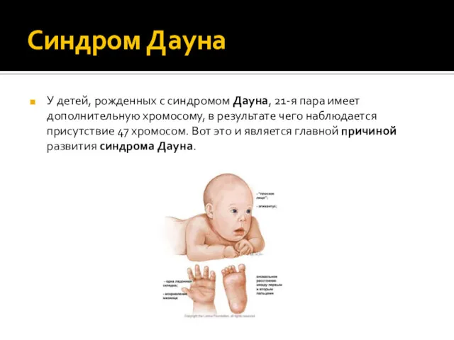 Синдром Дауна У детей, рожденных с синдромом Дауна, 21-я пара