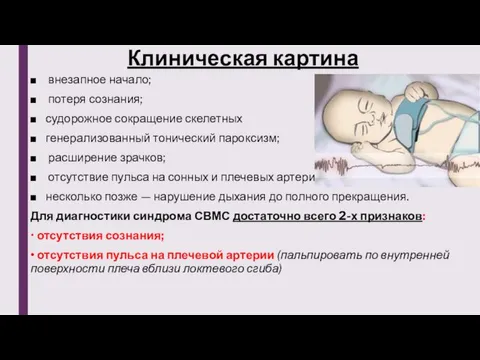 Клиническая картина внезапное начало; потеря сознания; судорожное сокращение скелетных генерализованный