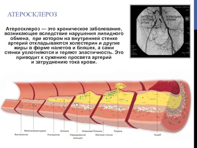 АТЕРОСКЛЕРОЗ Атеросклероз — это хроническое заболевание, возникающее вследствие нарушения липидного