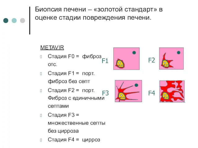 METAVIR Стадия F0 = фиброз отс. Стадия F1 = порт.фиброз