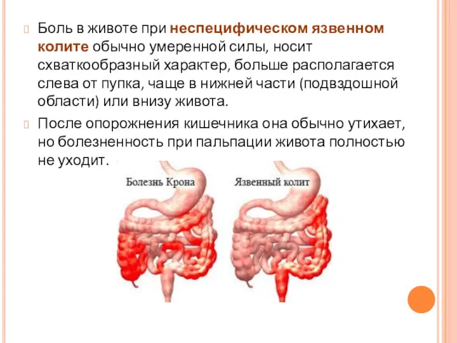 Боль в животе при неспецифическом язвенном колите обычно умеренной силы,