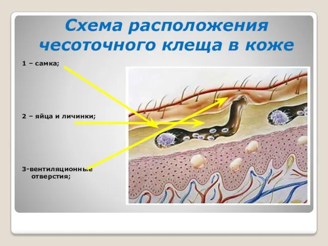 Схема расположения чесоточного клеща в коже 1 – самка; 2 – яйца и личинки; 3-вентиляционные отверстия;