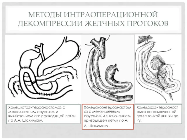 МЕТОДЫ ИНТРАОПЕРАЦИОННОЙ ДЕКОМПРЕССИИ ЖЕЛЧНЫХ ПРОТОКОВ Холецистоэнтероанастомоз с межкишечным соустьем и выключением его приводящей