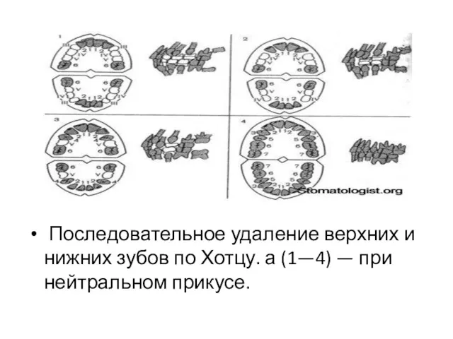 Последовательное удаление верхних и нижних зубов по Хотцу. а (1—4) — при нейтральном прикусе.