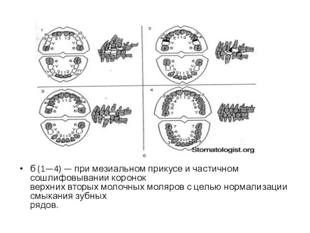 б (1—4) — при мезиальном прикусе и частичном сошлифовывании коронок