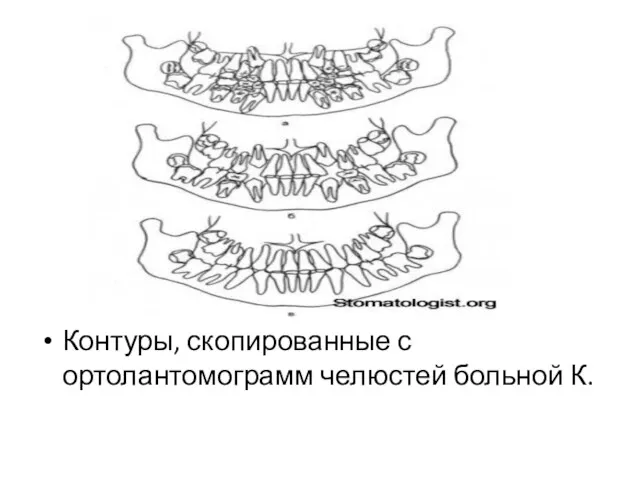 Контуры, скопированные с ортолантомограмм челюстей больной К.