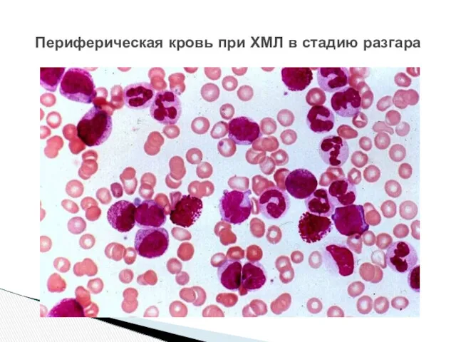 Периферическая кровь при ХМЛ в стадию разгара