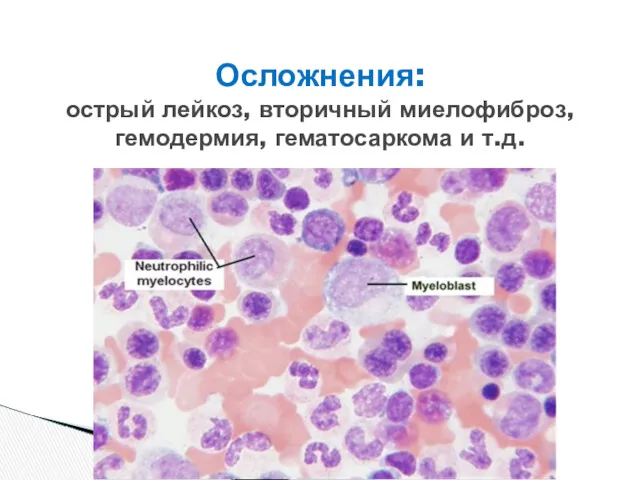 Осложнения: острый лейкоз, вторичный миелофиброз, гемодермия, гематосаркома и т.д.