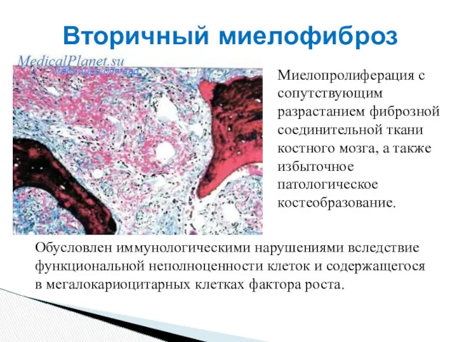 Вторичный миелофиброз Миелопролиферация с сопутствующим разрастанием фиброзной соединительной ткани костного