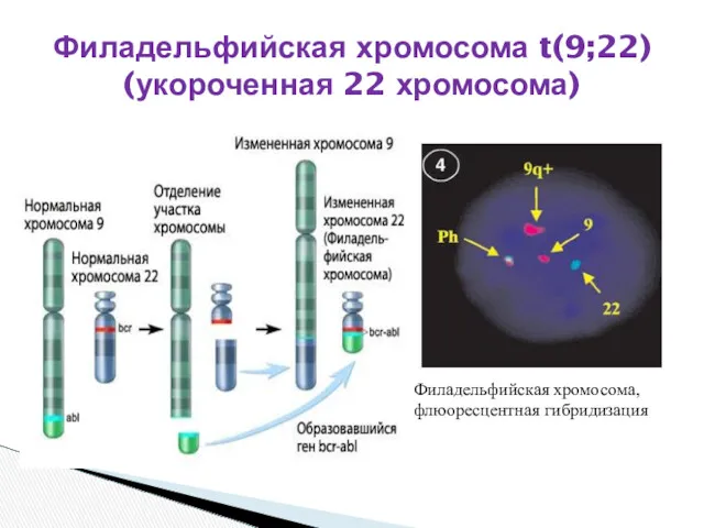 Филадельфийская хромосома t(9;22) (укороченная 22 хромосома) Филадельфийская хромосома, флюоресцентная гибридизация
