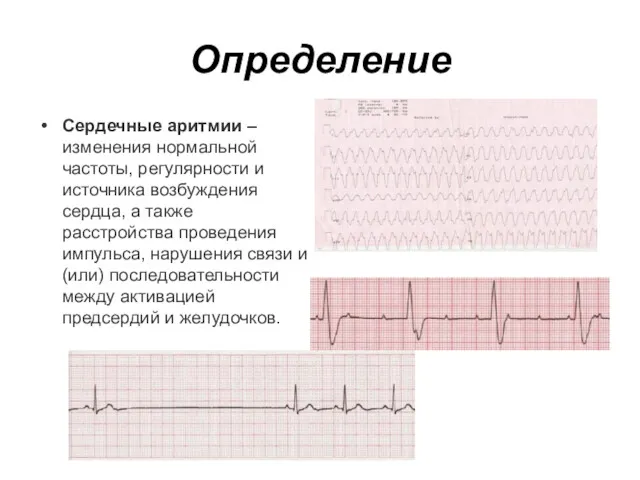 Определение Сердечные аритмии – изменения нормальной частоты, регулярности и источника возбуждения сердца, а